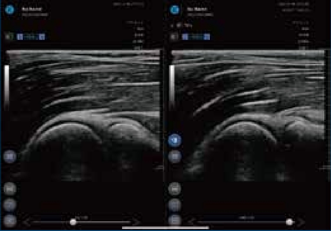 超音波画像診断装置 SONON エコー画像